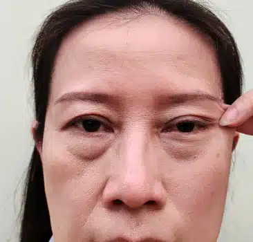 Blefaroespasmo e espasmo hemifacial — Toxina Botulínica Terapêutica na Gileade, Brasília