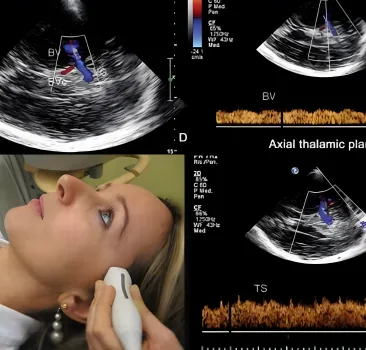 Doppler transcraniano — exame do fluxo sanguíneo cerebral na Gileade Centro Neurológico, Brasília